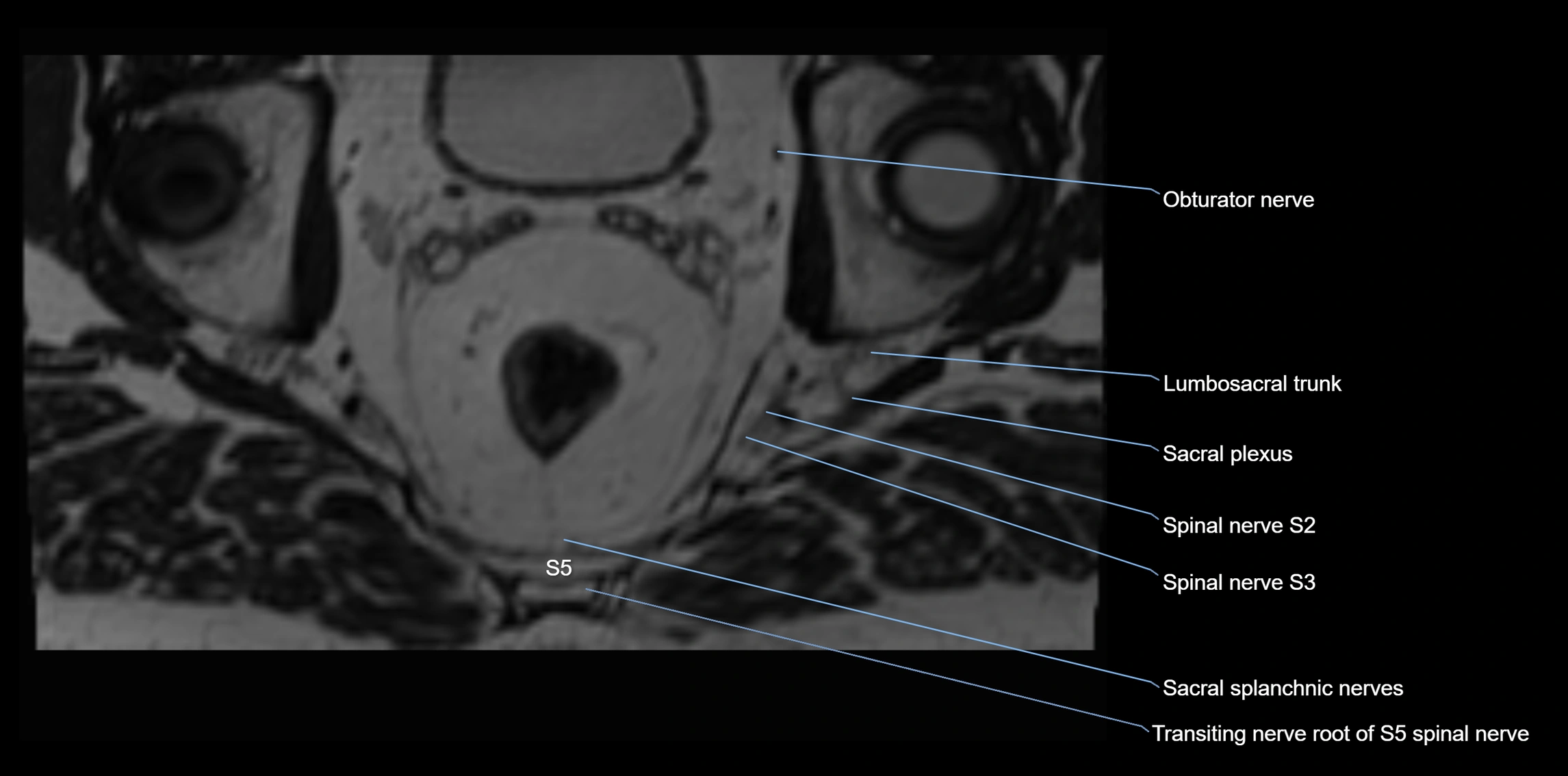 MR lumbosacral plexus axial cross sectional anatomy 3T  radiology  image-img-1008001-00112.webp